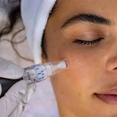 Glow Starter Microneedling at The It Girl Glow in Staten Island, NY