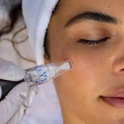 Glow Transformation microneedling at The It Girl Glow in Staten Island, NY